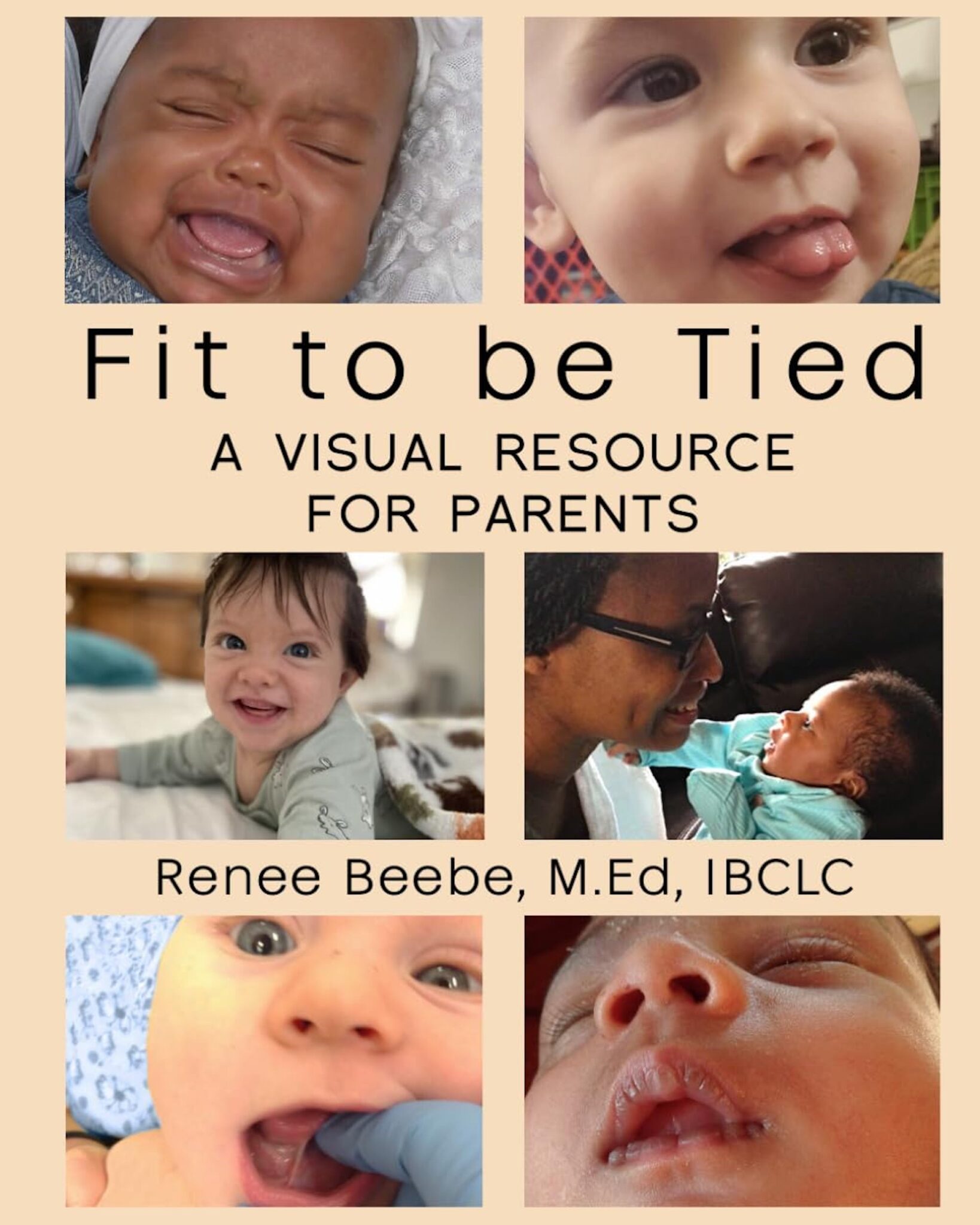 Tongue tie in newborns