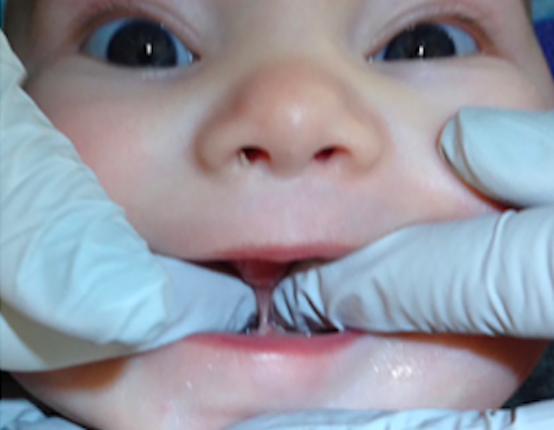 Tongue tie in newborns