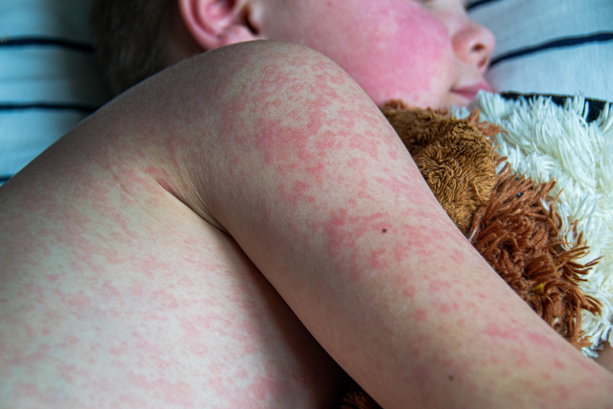 Measles cases reported King County