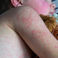 Viral disease. Measles rash on the body of the child. Allergy.