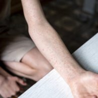 Measles rash in an adult.