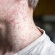 Measles viral disease, human skin covered with measles rash, vaccination concept